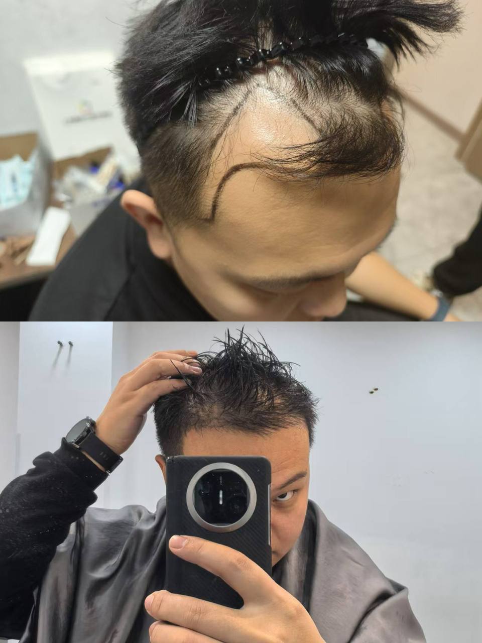 FUE result Shanghai hair transplant clinic