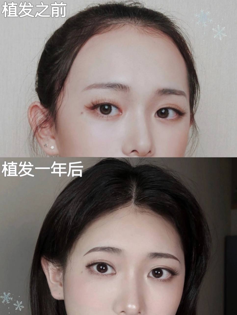 Hair restoration Singaporean client Shanghai