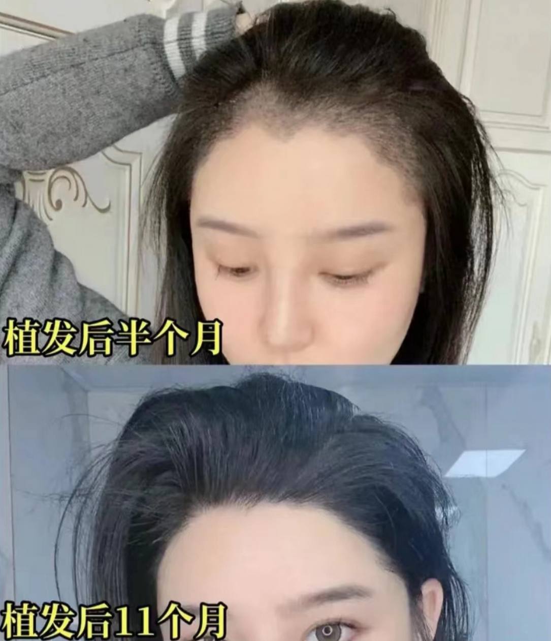 FUE hair transplant before after photo