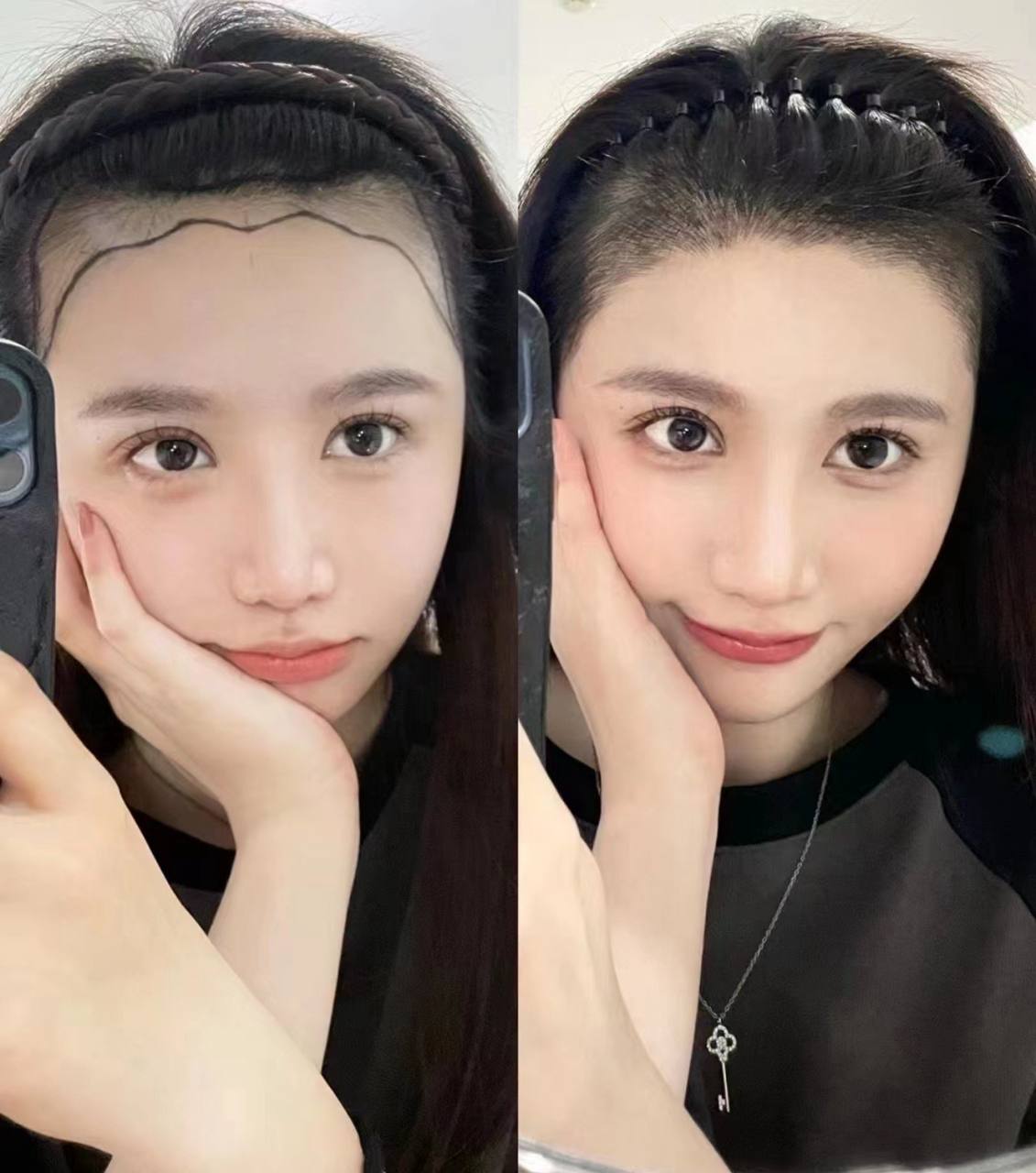 Shanghai hair transplant FUE result gallery