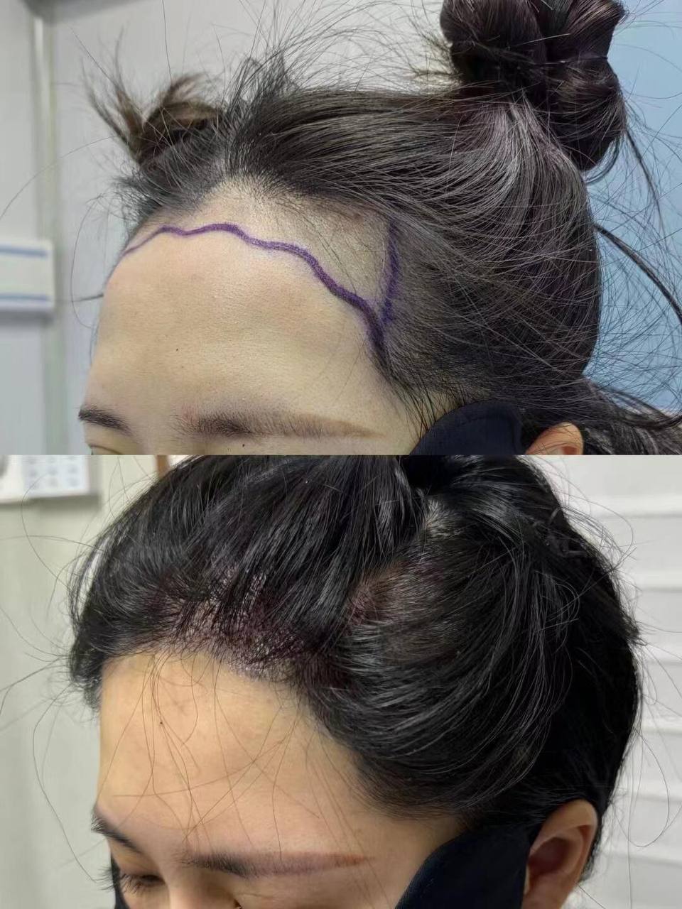 FUE hair transplant male pattern baldness