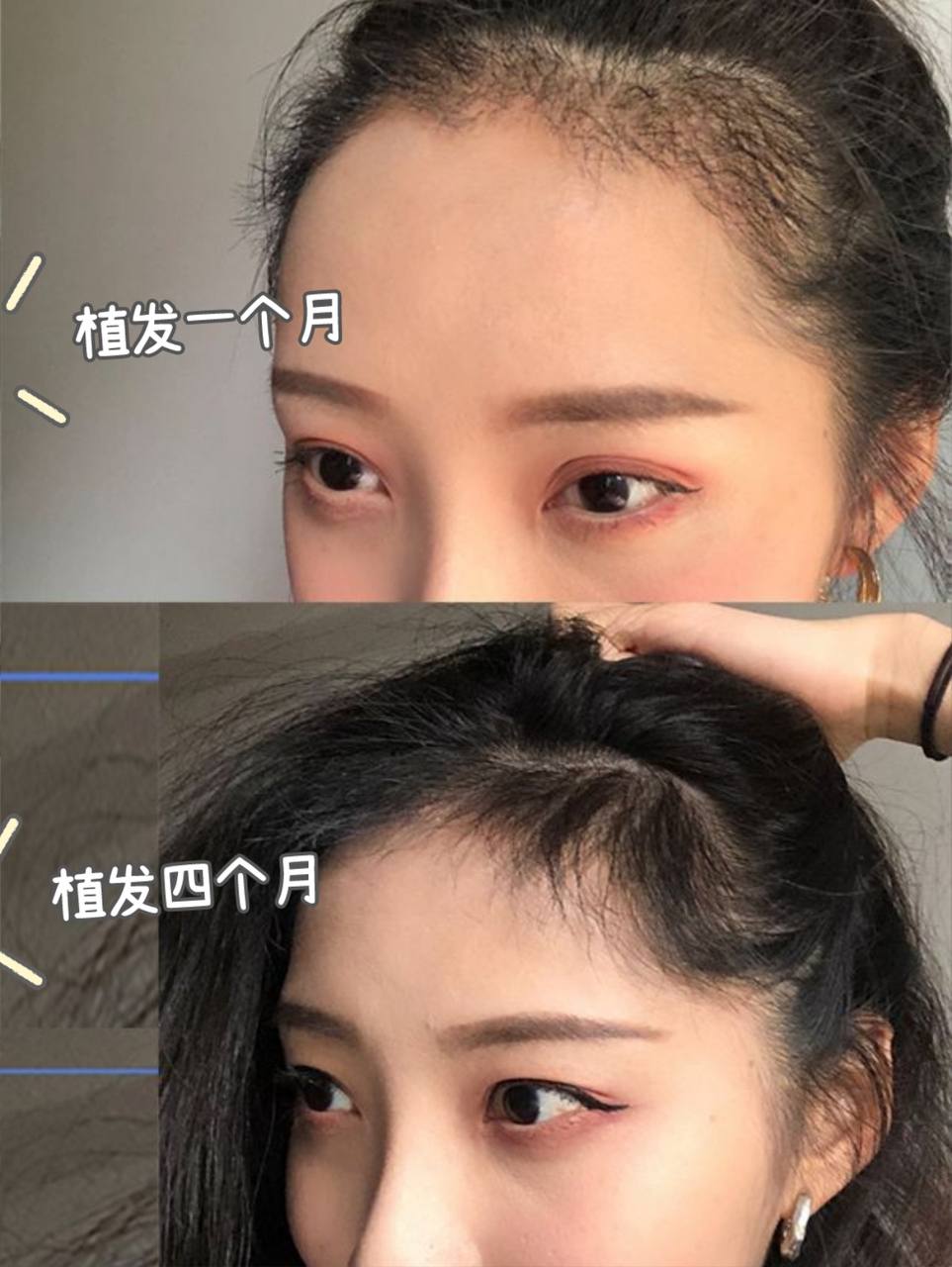 FUE hair transplant hairline reconstruction