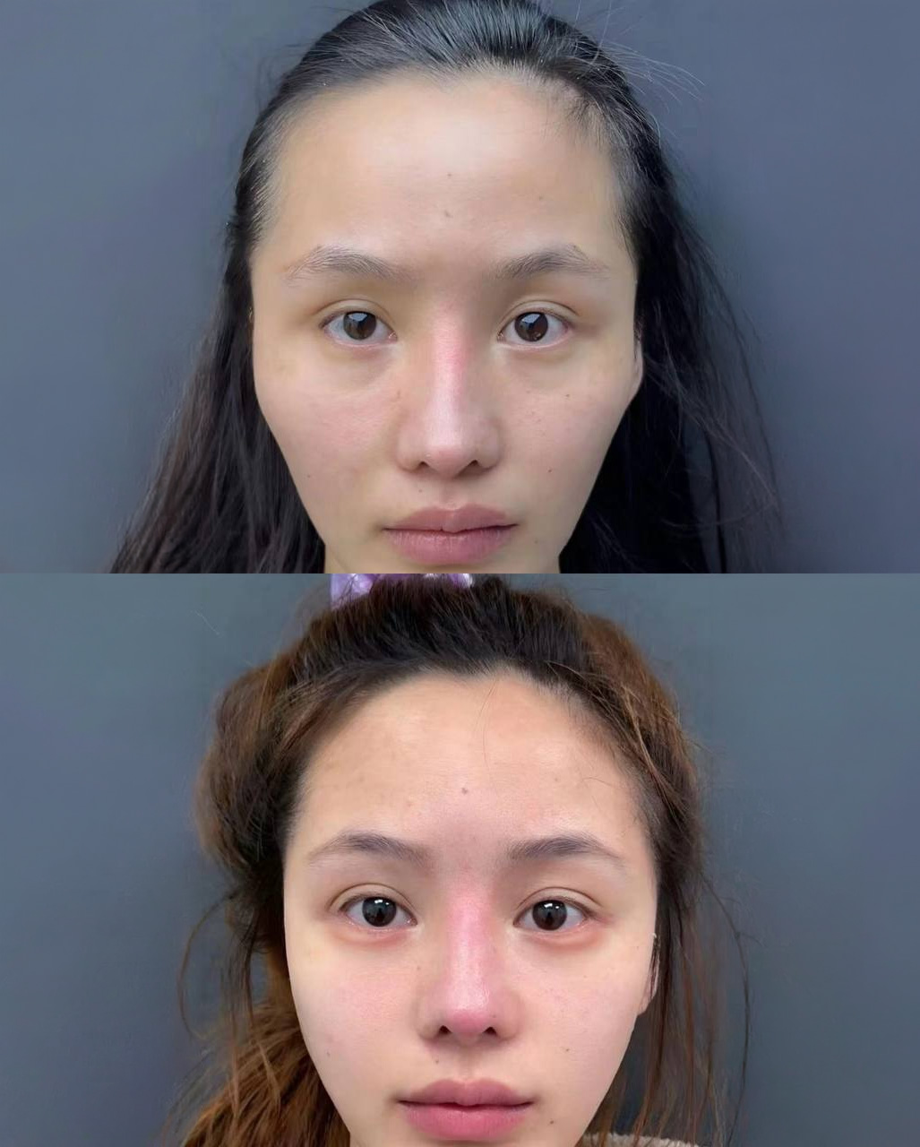 FUE hair transplant result international client