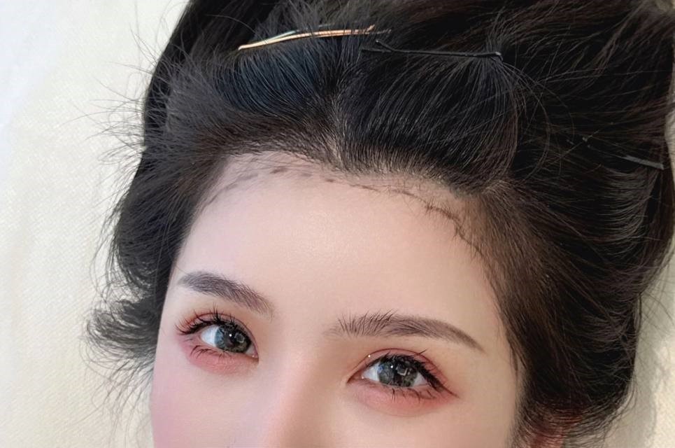 FUE hair transplant result — natural hairline restoration in Shanghai