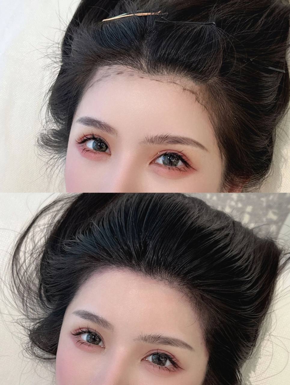 FUE hair transplant result Shanghai clinic