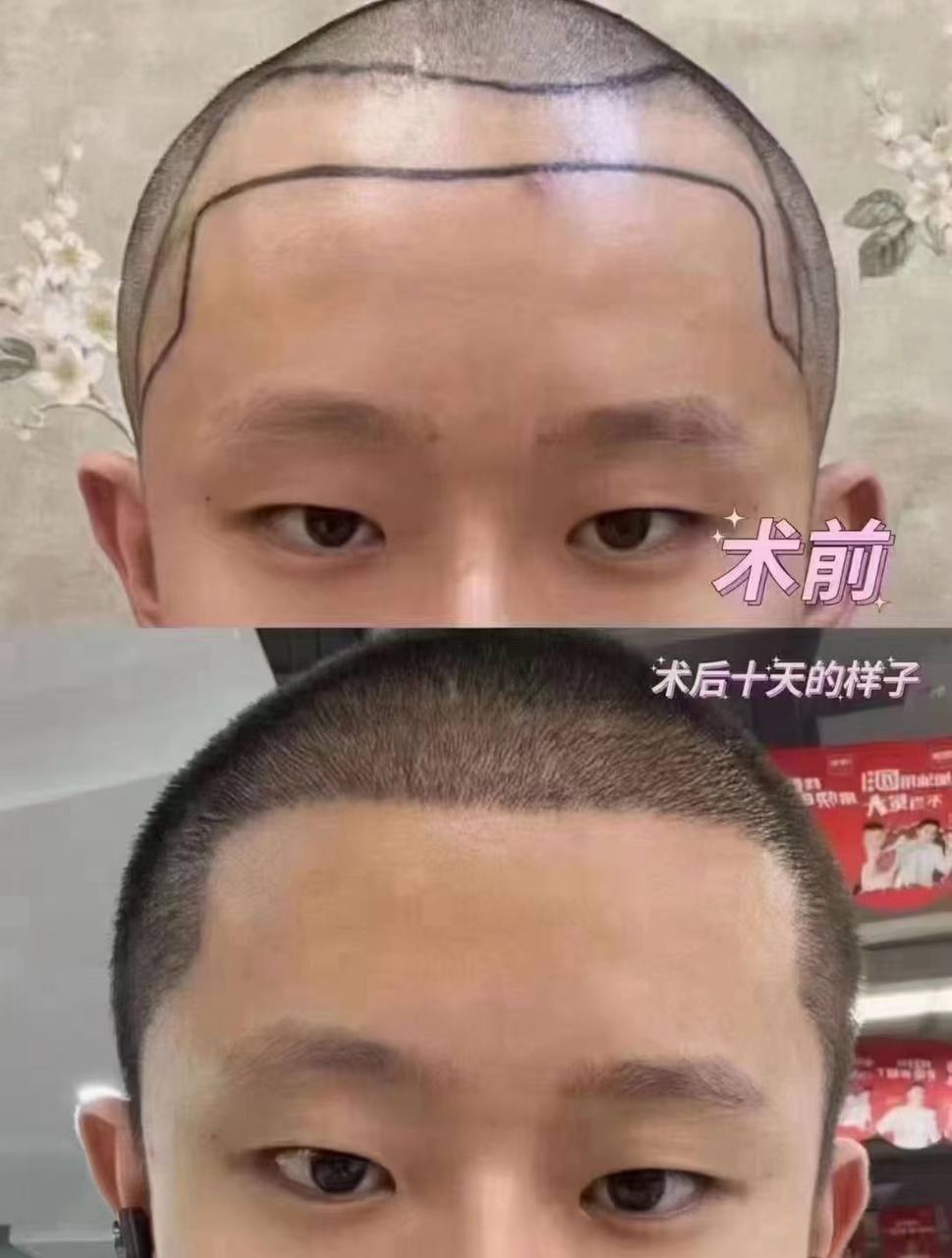 Hair restoration before after photo