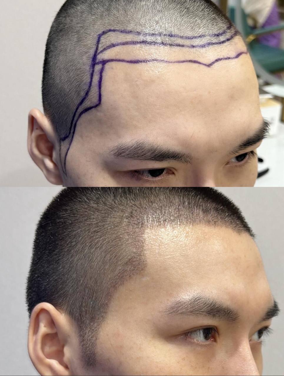 FUE hair transplant female hairline before after