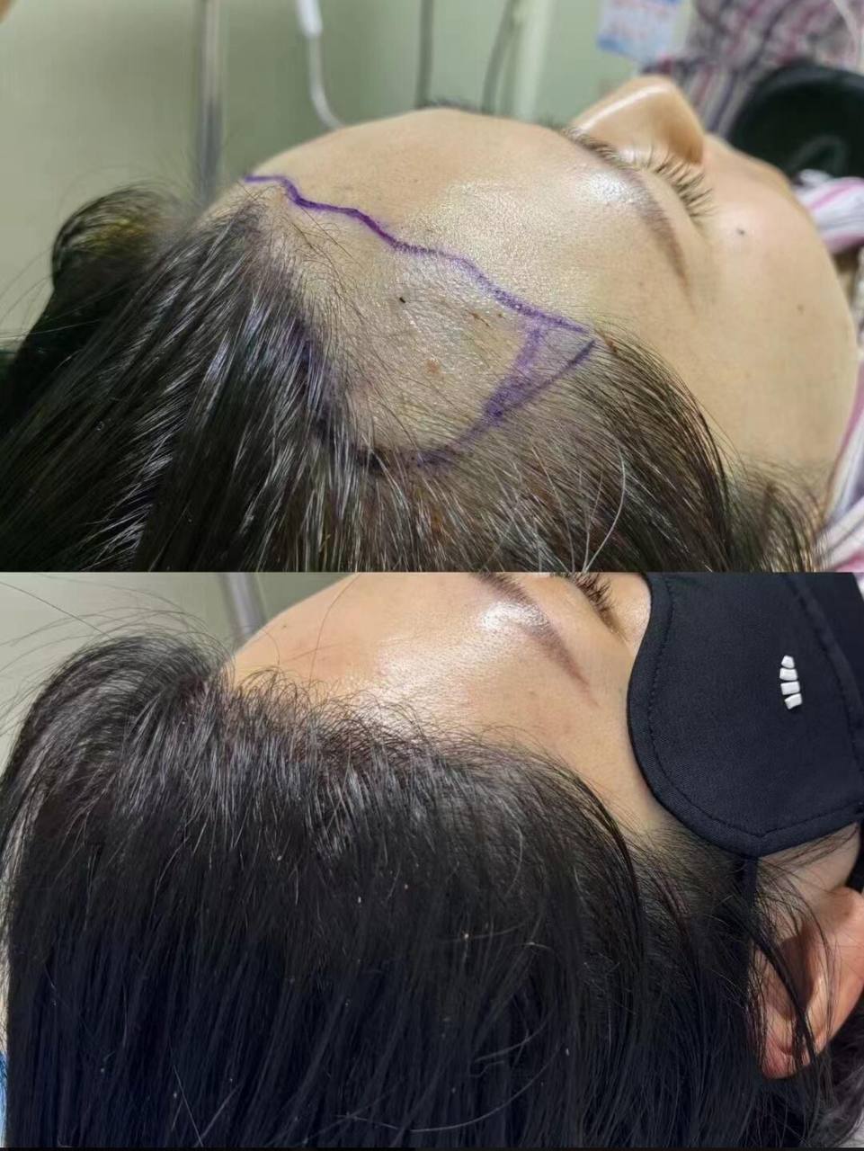 Hair transplant graft result before after