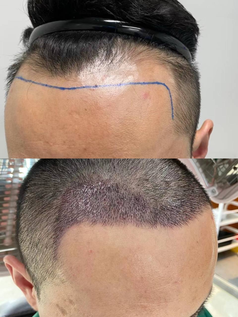 FUE hair restoration international client