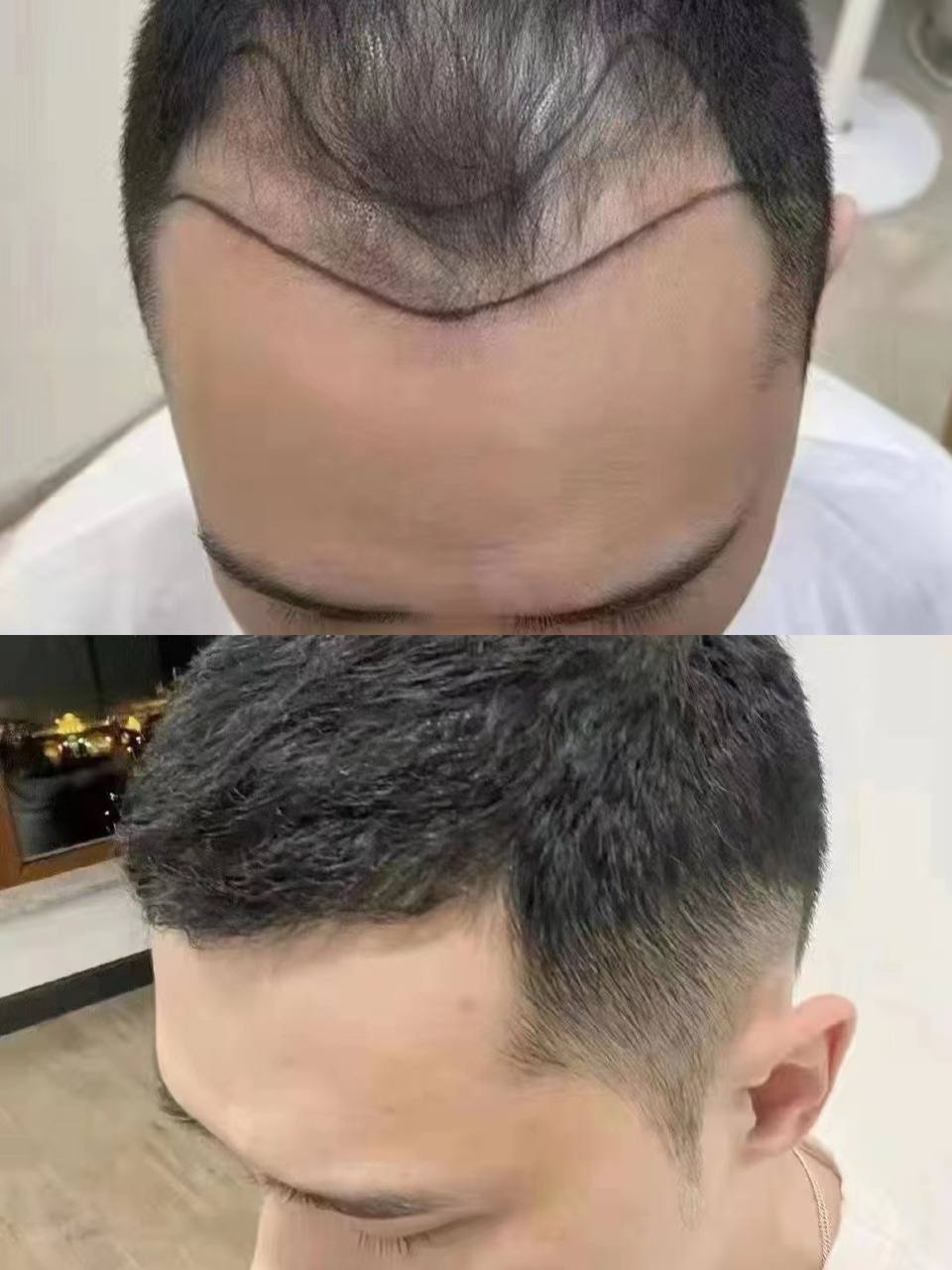 Hair transplant before after temple recession