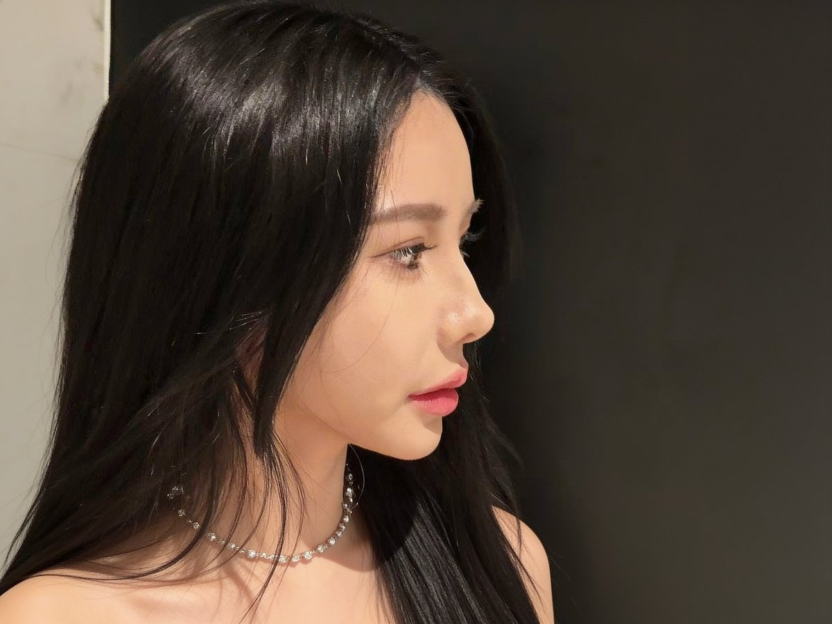 Rhinoplasty result in Shanghai