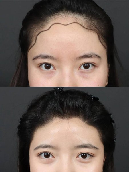 FUE Hair Transplant — Hairline Design