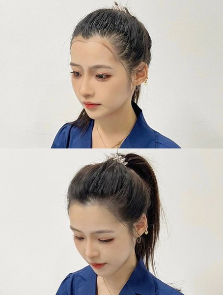 FUE Hair Transplant — Before & After