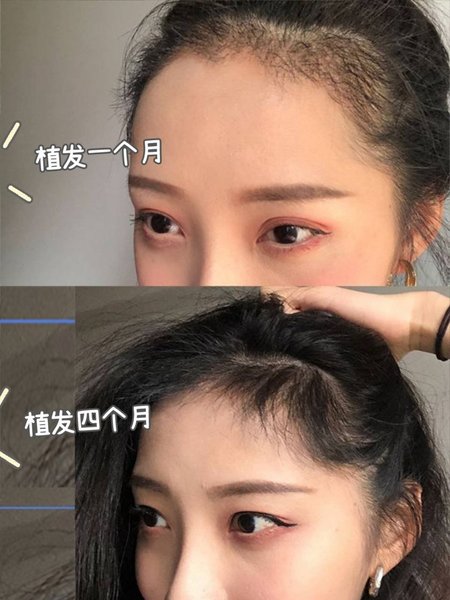 FUE Hair Transplant — 1 Month to 4 Months