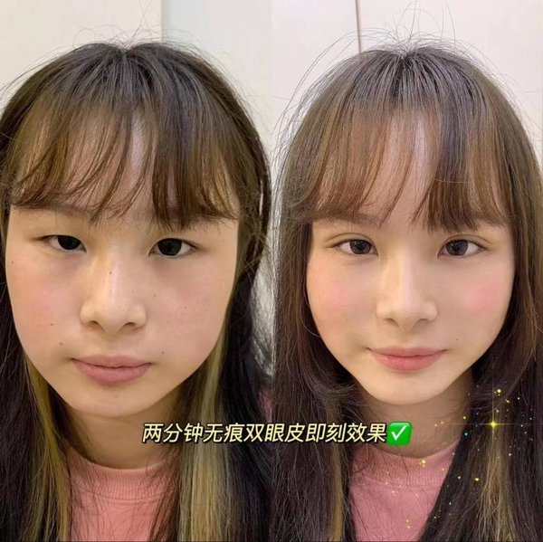 Eyelid Surgery — Before & After