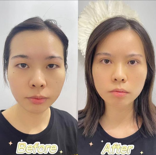 Eyelid Surgery — Before & After