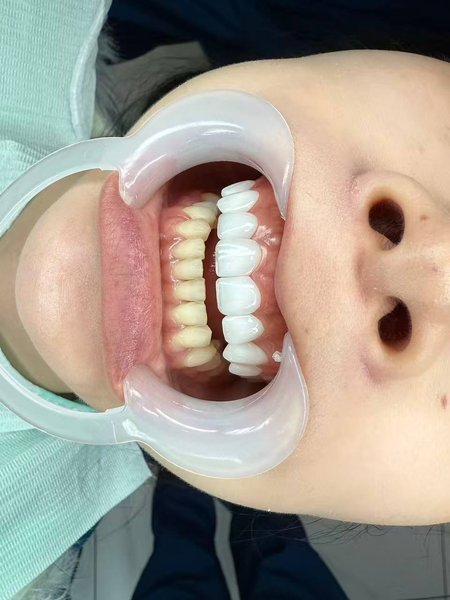 Porcelain Veneers — During Procedure