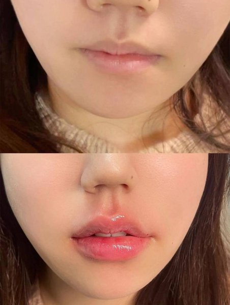 Lip Enhancement — Before & After