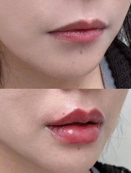 Lip Enhancement — Before & After
