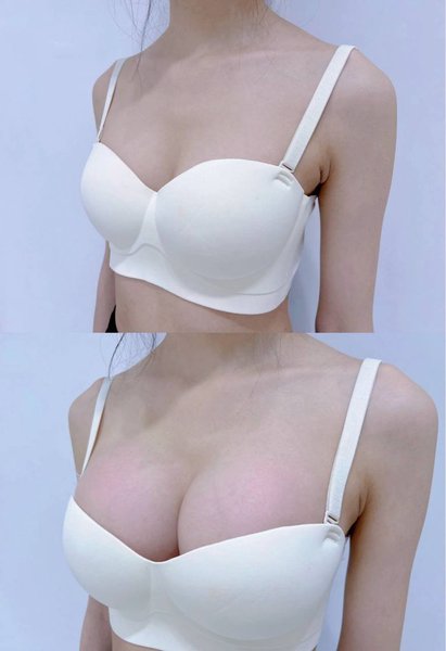 Breast Augmentation — Before & After
