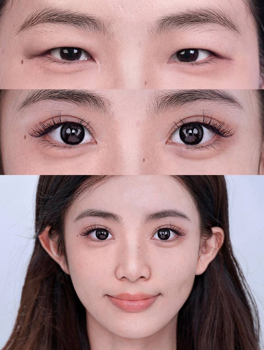 Eyelid Surgery result in Shanghai