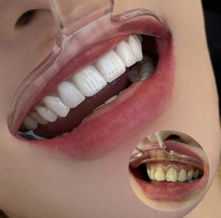 Porcelain veneers before and after — natural smile transformation in Shanghai