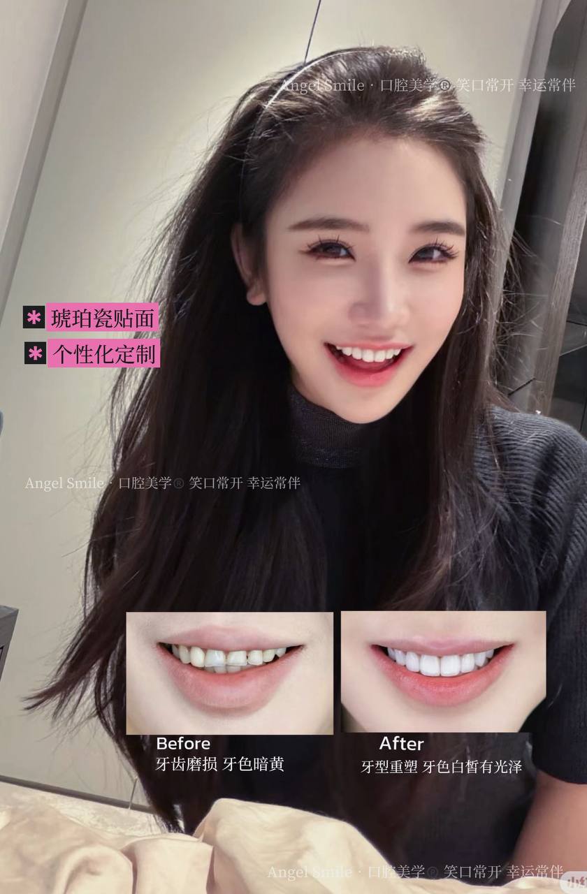 Porcelain veneer result — before and after smile transformation Shanghai