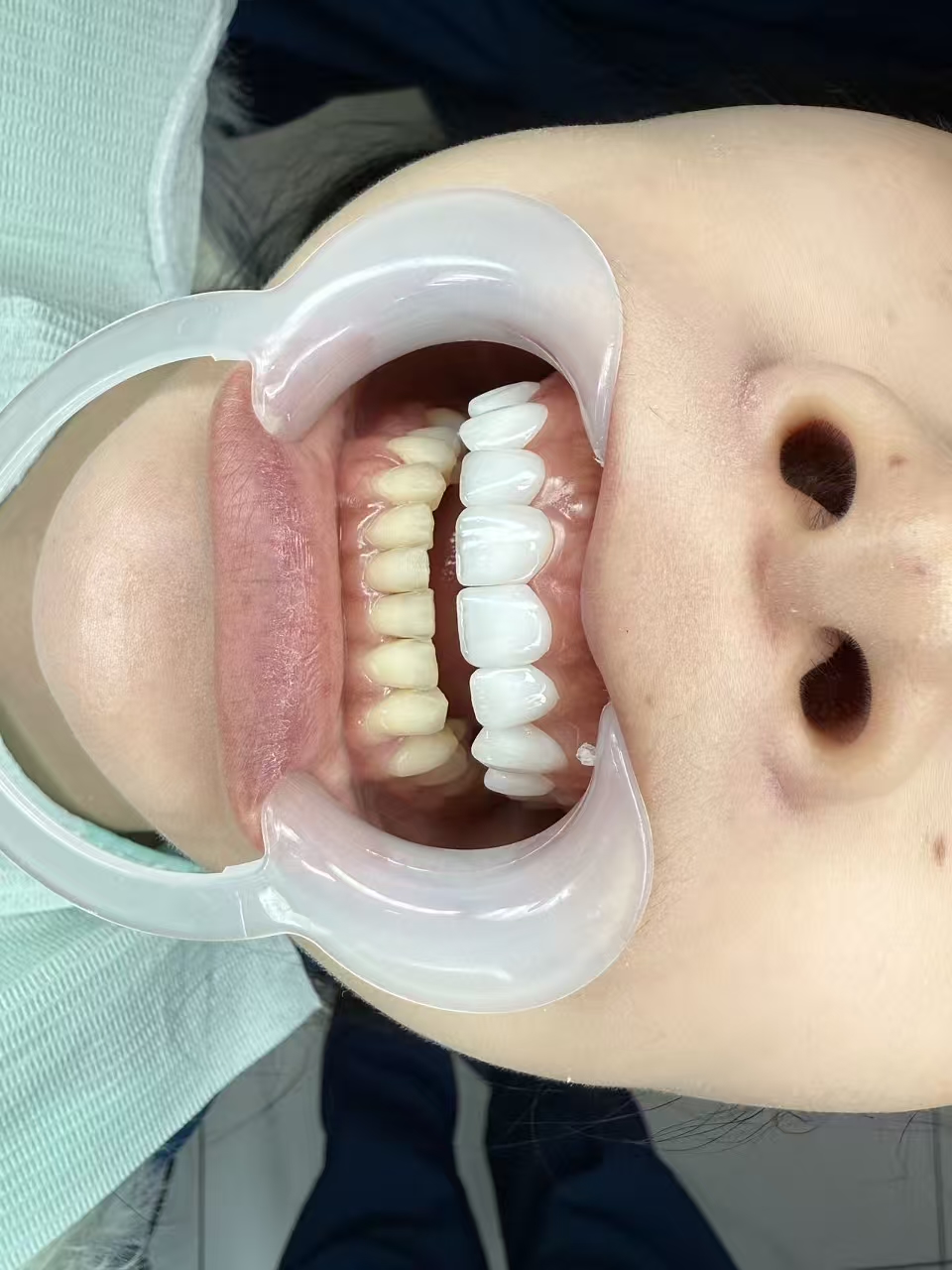 Porcelain veneer results — before and after Vday Shanghai